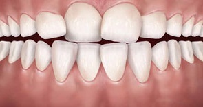 فضای کم دندانی