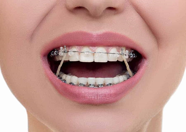 هرآنچه درباره ارتودنسی دندان باید بدانید